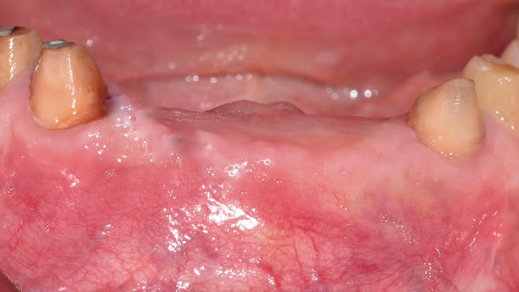 Костная пластика GBR