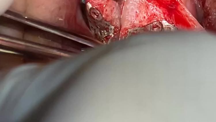 Аугментация гребня титановой сеткой