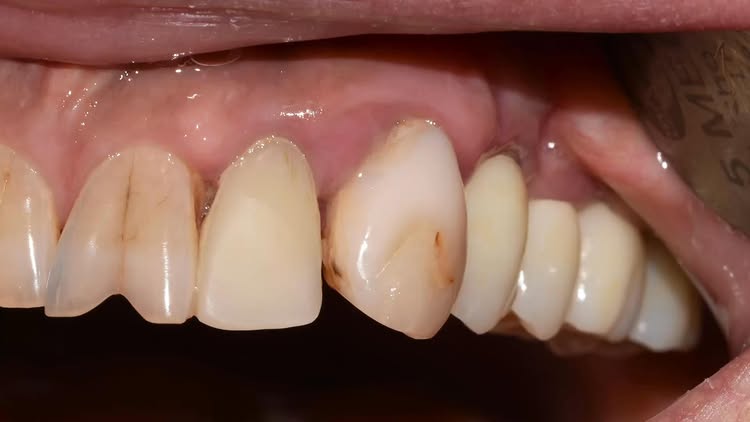 Имплантация зубов